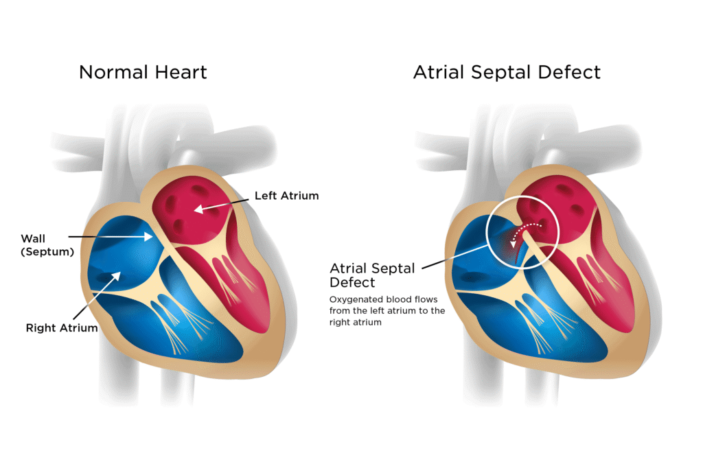 Atrial Septum Defect